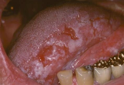 Oral leukoplakia is one such condition. Oral Hairy Leukoplakia - Pictures, Causes, Treatment, Symptoms