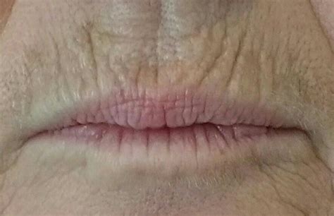 Injections d'acide hyaluronique au dessus de la lèvre ...