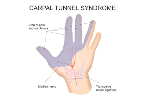At first, you're most likely to notice it at night or when you first wake up in the morning. Carpal Tunnel Syndrome Newcastle | Poke Acupuncture