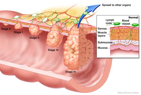 When colon cancer is detected in its early stages, it may not have even caused symptoms. Colon Cancer : Suncoast Surgical Associates