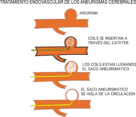 Un aneurisma cerebral es una enfermedad cerebrovascular caracterizada por una dilatación de la ¿en qué consiste el tratamiento? Síntomas del aneurisma cerebral y tratamiento - Demedicina.com