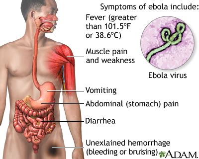 It was initially detected in 1976 in sudan and the democratic republic of congo. Multimedia Encyclopedia - Penn State Hershey Medical ...