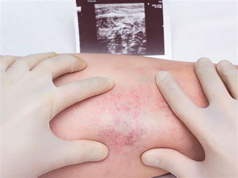 Los expertos indican que la trombosis venosa profunda (tvp) es una enfermedad que puede conducir a graves complicaciones en el organismo. Trombosis Venosa - Caracteristicas De La Trombosis Venosa ...