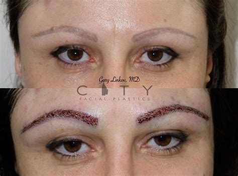 Fue, or follicular unit extraction, is an extremely effective form of hair transplant. NYC Eyebrow Restoration | New York Eyebrow Hair Transplant ...