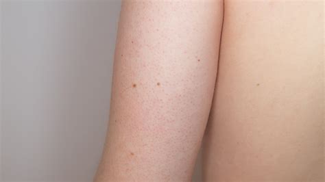 We tried every keratosis pilaris treatment, from oil pulling and acids to lotions and scrubs. Keratosis Pilaris: Diagnosis, Causes, & Treatment ...