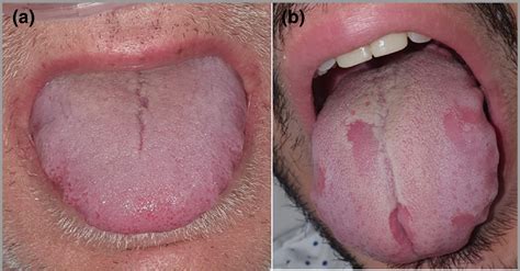 Facts about COVID Tongue: Peculiar virus Symptoms, Signs of Infection ...