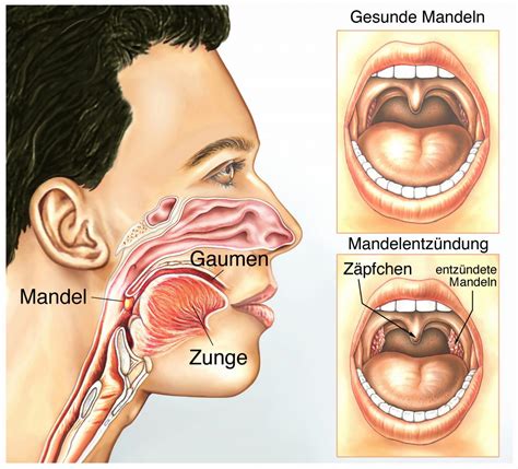 So symptome im internet und von autisten selber in videos etc Experte: Wann müssen die Mandeln wirklich raus?