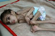 malnourished yemen reuters yemeni hunger malnutrition cerebral faid weighs palsy ravaged blockade tragic samim sanaa usnews