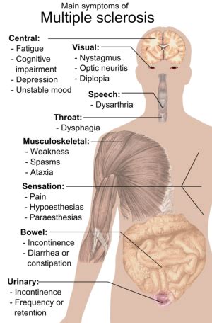 Multiple sclerosis is a long term disorder that has no cure. MS Multiple Sclerosis - Physiopedia