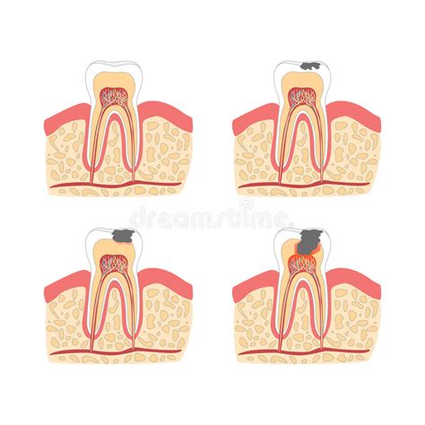 Pourquoi j'ai mal aux dents? Formation De Carie Dentaire Illustration de Vecteur ...