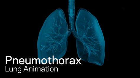 A pneumothorax can be caused by: Pneumothorax - YouTube