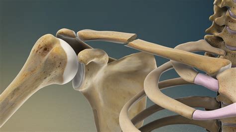 They break down any extra bone that formed during healing so your bones get back to their regular shape. Diagram Of Common Back Bone Break ~ Shoulder Pain Causes ...