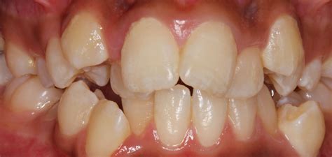 A crossbite can occur in any area where the teeth in the upper jaw fall inside the teeth in the. Before and After Gallery | Precision Smiles