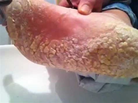 Skin peeling on feet bottom manifests in all people young and old alike. Dry cracked foot skin - YouTube