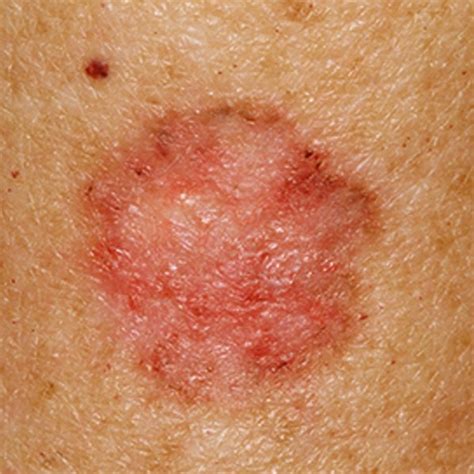 A cell structure in which the functions are carried out to ensure the cell`s survival. Basal Cell Carcinoma Pictures