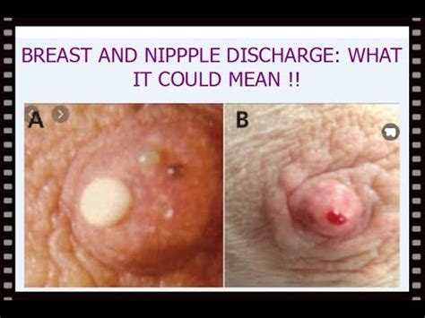 — so that it's easier to understand why. Breast and Nipple Discharge: What It Could Mean - YouTube