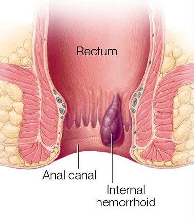 Although conservative nonsurgical treatment (stool softeners, increased. Hemorrhoids Guide | Hemorrhoids Treatment in NYC ...