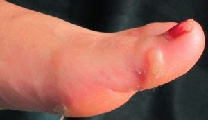 Most blisters heal naturally, simply because new skin grows underneath the blister and your body reabsorbs the 4. How to Treat a Foot Blister?