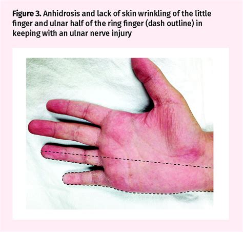Pediatric hand injuries | The College of Family Physicians ...