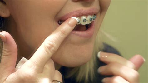 Place wax on the bracket wire etc that is bothering you. Using Wax with Braces - YouTube