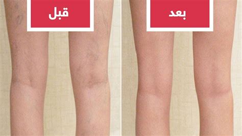 We did not find results for: علاج دوالى ااساقين دكتور مازن السقا - Ø¬Ø¯ÙŠØ¯ Ø¹Ù„Ø§Ø¬ Ø ...