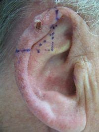 You can also share how long does tinnitus last after ear infection? Skin cancer on the ear - Case 1 - Pei-Pei Cheang