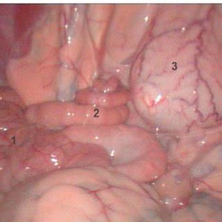 Maybe you would like to learn more about one of these? Photograph showing laparoscopic view of pelvic organs and ...