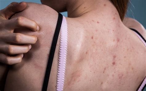 Weitere ideen zu akne hausmittel, akne narben entfernen, zystische akne. Wie wird man Rückenakne (Backne) los? | Nie mehr Akne