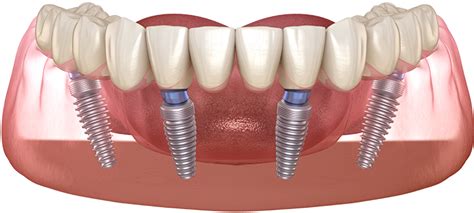 Dental Implants - Beck Family Dental, LLC