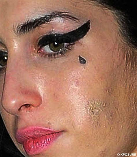 The cause of stretch marks is stretching of the skin. Ugly rash on Amy Winehouse's face shows hard living has ...