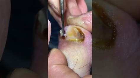 If you shave against the grain, then sometimes you're pushing the hair back in the the skin and it can't poke back out, dr. High tech pull out Ingrown Nail 3 - YouTube