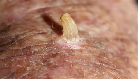 If there is pain associated then the chances of it being a folliculitis is more. Cutaneous Horn - Removal, Pictures, Treatment, Causes, Signs