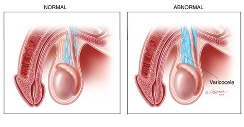 Varicoceles (swollen veins in the scrotum) affect 1 in 5 men, usually causing mild or no symptoms. Varicoceles and Male Fertility - human-fertility.com