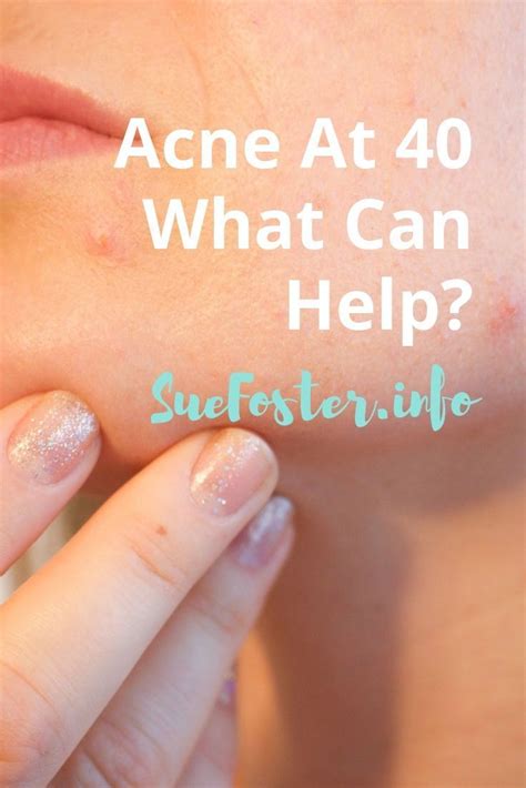 Many acne products contain ingredients that dry the skin, so always use a moisturizer that minimizes these acne products don't need a prescription. Acne At 40 What Can Help? | suefoster.info in 2020 | Acne ...