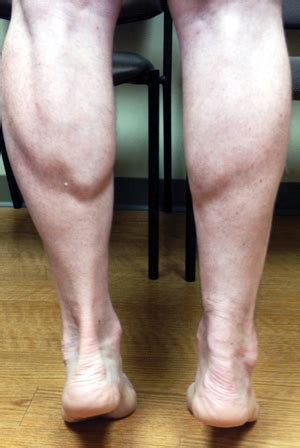 Achilles tendon rupture is when the achilles tendon, at the back of the ankle, breaks. Achilies Tendinitis | China| PDF | PPT| Case Reports ...