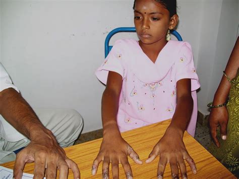 Acwerk 2010 - Clinic's: Skin & Early Leprosy-14 July