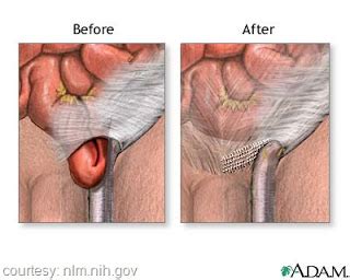 Blausen 0560 inguinalhernia by bruceblaus. Inguinal Hernia Repair Nursing Management - RNpedia