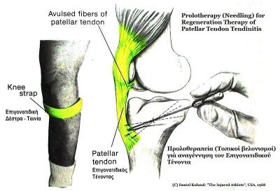 It is most commonly observed in athletes and sports persons, especially those who play sports like football, soccer, badminton, etc. דלקת גיד הפיקה - Patellar Tendonitis - ויקירפואה