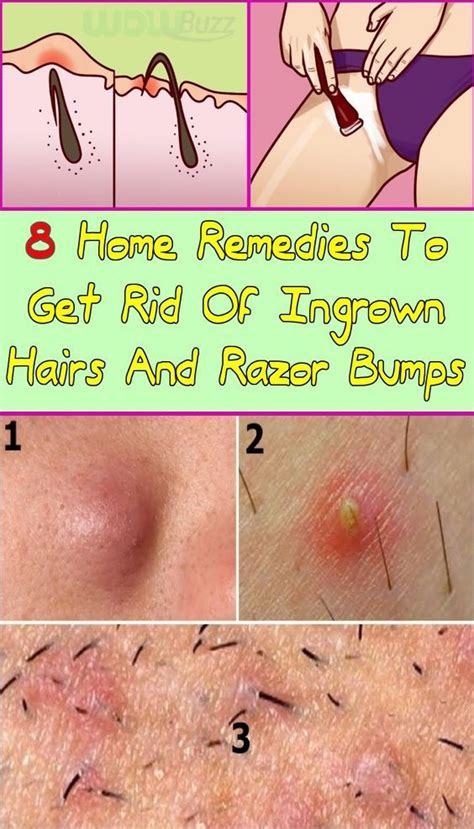 However, the situation worsens with the growth of infection. 8 Home Remedies to Get Rid of Ingrown Hairs and Razor ...