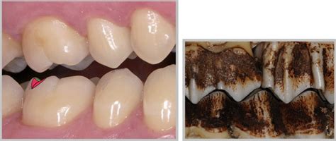 The group function occlusion on working side distributes the occlusal load and prevents teeth on non working side from being subjected to the destructive laterotrusive occlusal schemes and their effect on supra‑hyoid 2. Mastication : Mise en place de l'occlusion - THE OCCLUSAL ...