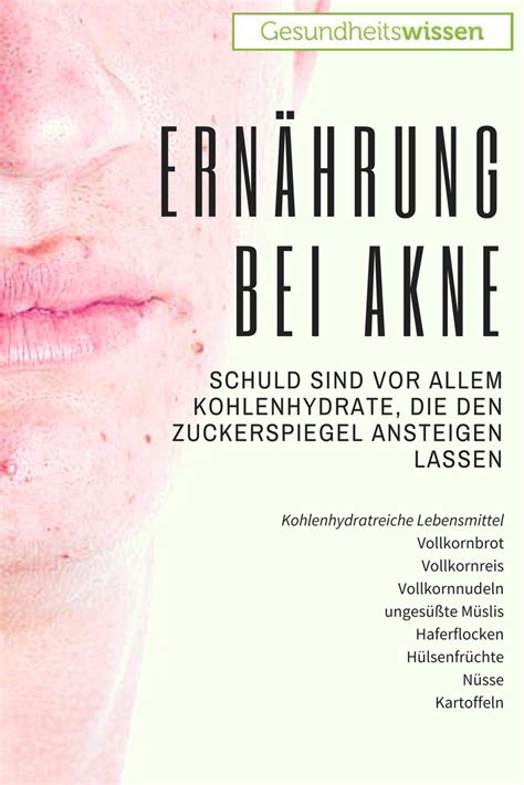 Sie bilden unschöne beulen auf der hautoberfläche und verursachen in vielen fällen schmerzen. Akne (mit Bildern) | Unreine haut, Akne, Pickel unter der haut