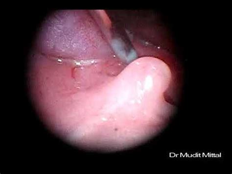 Have you had a gum. Retro-Pharyngeal Abscess in 2 month Old child Trans-Oral ...