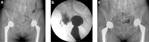 Groin muscles diagram groin rehab and prehab for groin pain and groin pull youtube. (a) This 54-y-old female patient complained of refractive ...