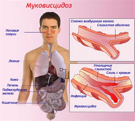 Как выбрать лекарство от кашля для детей и взрослых? Муковисцидоз - это что за болезнь и как она выглядит. Фото ...