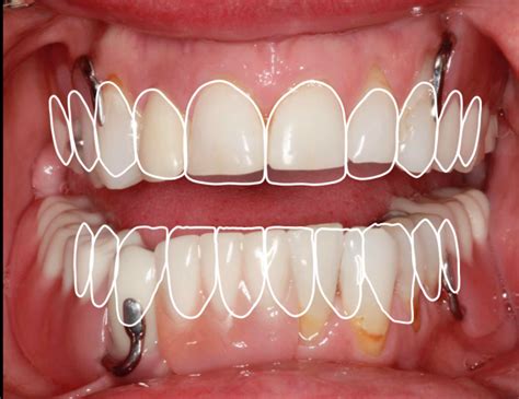 An avadent denture is a denture computer generated and literally becomes a computer file that allows us to now replace you denture if it's lost or worn after years of function for a fraction of the cost. A Step-by-Step Guide to Converting Denture to Interim ...