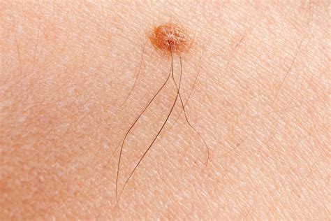 Skin cancer can occur anywhere on the body, so be thorough. The Early Signs of Skin Cancer - Dermatologist in Milford, CT