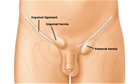 When stretching your groin muscles, there are a variety of types of stretches as you move your legs and hips around to warm them up, be aware of any areas that give you pain or discomfort. Lump in groin female and male, causes and diagnosis