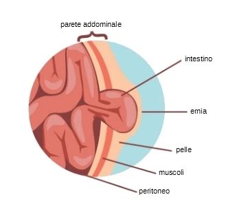 Il sintomo caratteristico dell'ernia inguinale è un netto rigonfiamento sotto la pelle nella regione dell'inguine. L'ernia inguinale - Intervista al dott. Massimo Mauri ...