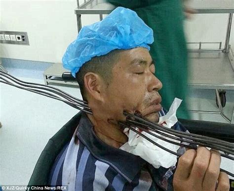 A century later, the technology is still quite popular. Builder impaled through neck by six metal bars in China ...