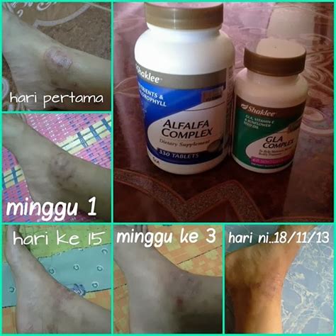 Obat penyakit kulit alami ini hanya dilakukan untuk pengobatan luar. Atasi Penyakit Kulit, Kurap dan Gatal | Sihat, Cantik ...